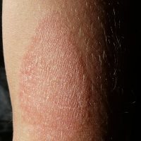 Pakhovy neurodermatitis trattamento
