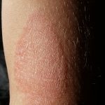 Dermatite Atopica