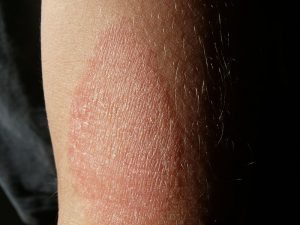 Dermatite Atopica