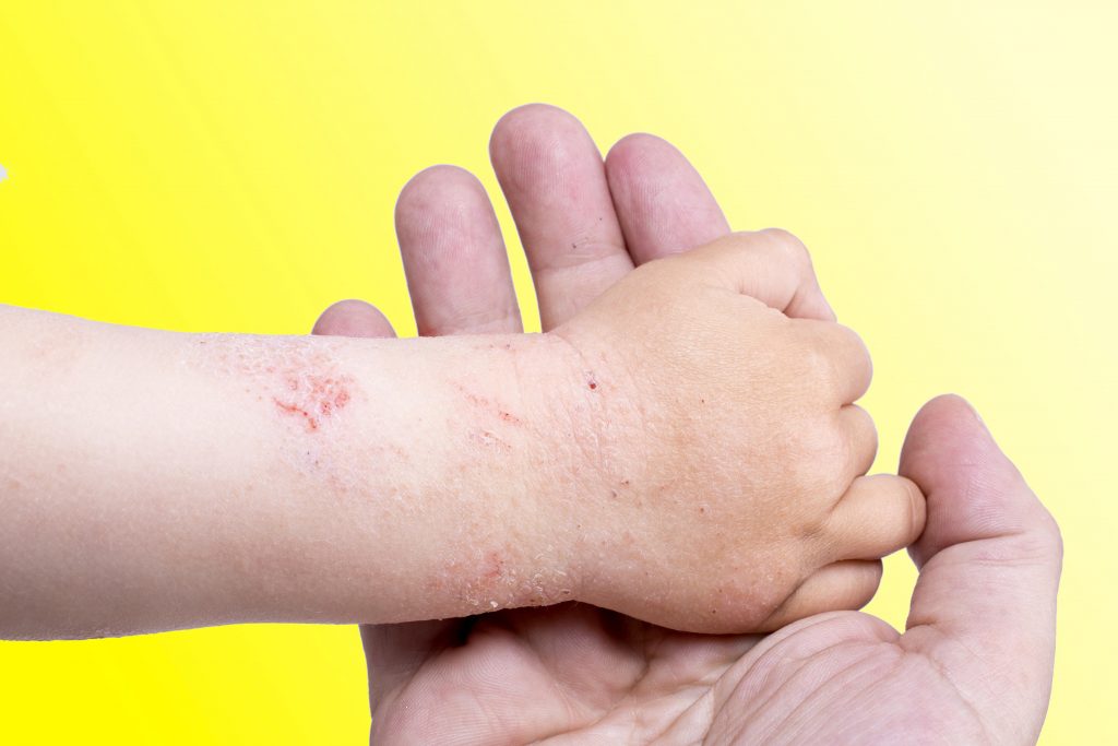 nuova crema contro la dermatite atopica