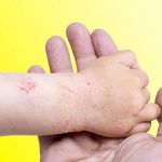 nuova crema dermatite atopica-2